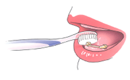 mondhygiene implantaten